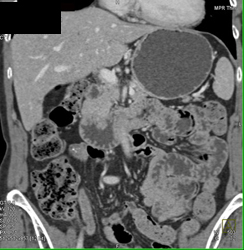 Ampullary Cancer - CTisus CT Scan