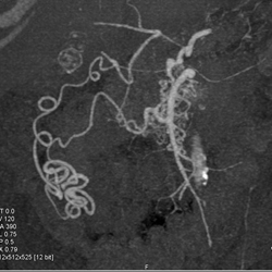 Collaterals Off SMA - CTisus CT Scan