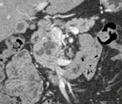 Intraductal Papillary Mucinous Neoplasm (IPMN) - CTisus CT Scan