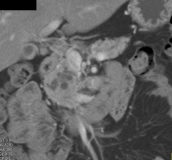 Intraductal Papillary Mucinous Neoplasm (IPMN) - CTisus CT Scan