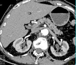 Islet Cell Tumor - CTisus CT Scan