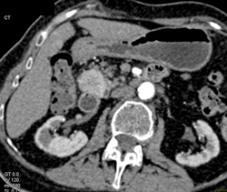 Islet Cell Tumor - CTisus CT Scan