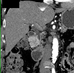 Islet Cell Tumor - CTisus CT Scan