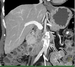 Islet Cell Tumor - CTisus CT Scan