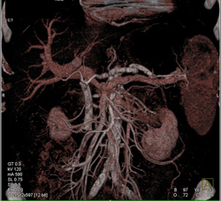 Pancreatic Cancer With Stent - CTisus CT Scan