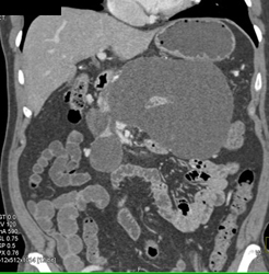 Pseudocyst - CTisus CT Scan