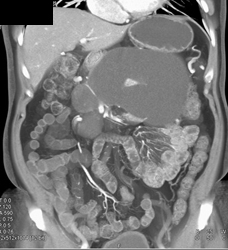 Pseudocyst - CTisus CT Scan