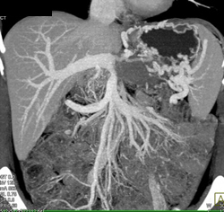 Occluded Splenic Vein With Varices - CTisus CT Scan