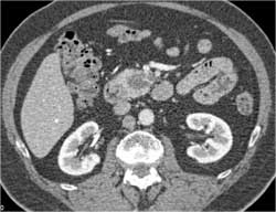 Intraductal Papillary Mucinous Neoplasm (IPMN) - CTisus CT Scan