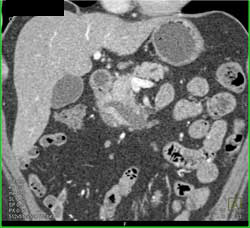 Intraductal Papillary Mucinous Neoplasm (IPMN) - CTisus CT Scan