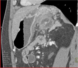 Inflammation Near Pancreas and Stomach Due to Pancreatitis - CTisus CT Scan