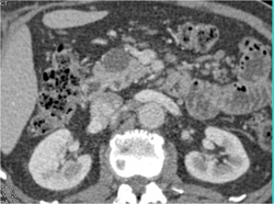 Intraductal Papillary Mucinous Neoplasm (IPMN) - CTisus CT Scan