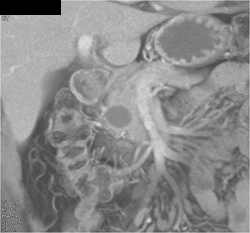 Intraductal Papillary Mucinous Neoplasm (IPMN) - CTisus CT Scan