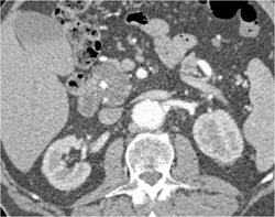 Intraductal Papillary Mucinous Neoplasm (IPMN) - CTisus CT Scan