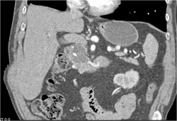 Intraductal Papillary Mucinous Neoplasm (IPMN) - CTisus CT Scan