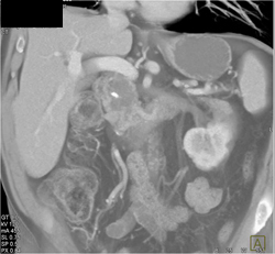 Intraductal Papillary Mucinous Neoplasm (IPMN) - CTisus CT Scan