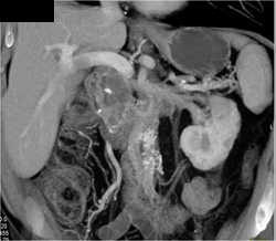 Intraductal Papillary Mucinous Neoplasm (IPMN) - CTisus CT Scan