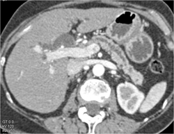 Subtle Pancreatic Carcinoma- Note Common Bile Duct (CBD) and Pancreatic Duct Dilation - CTisus CT Scan