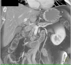 Atrophic Pancreatic Gland - CTisus CT Scan