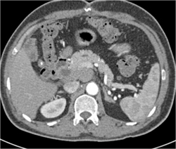 Pancreatic Adenocarcinoma With Usual Encasement - CTisus CT Scan