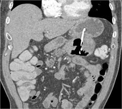 Pseudocyst With Stent Into Stomach - CTisus CT Scan