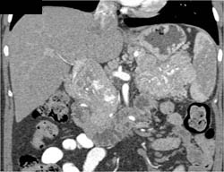 Islet Cell Tumor - CTisus CT Scan