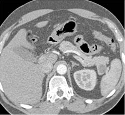 Splenic Tissue Simulates A Pancreatic Intraductal Papillary Mucinous Neoplasm (IPMN) - CTisus CT Scan