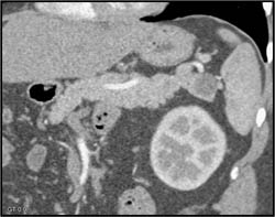 Cystic Lesion- Tail of Pancreas Was Splenic Tissue at Surgery - CTisus CT Scan