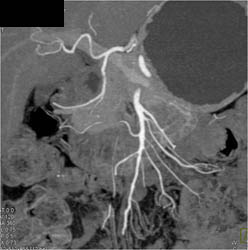 Normal Mesenteric Map - CTisus CT Scan