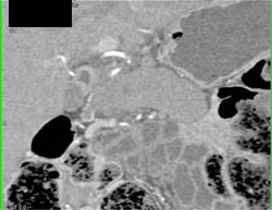 Autoimmune Pancreatitis - CTisus CT Scan