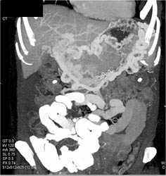 Portal Vein (PV) Occlusion With Extensive Collaterals - CTisus CT Scan