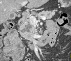 Intraductal Papillary Mucinous Neoplasm (IPMN) - CTisus CT Scan