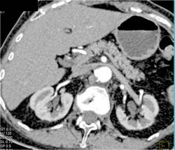 Islet Cell Tumor - CTisus CT Scan