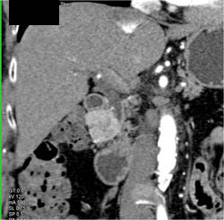 Islet Cell Tumor - CTisus CT Scan