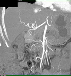 Islet Cell Tumor - CTisus CT Scan