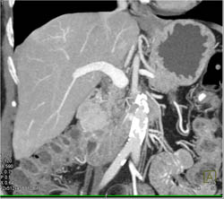 Islet Cell Tumor - CTisus CT Scan