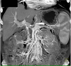 Pancreatic Cancer Encases the PV/SMV With Stent in the Common Bile Duct (CBD) - CTisus CT Scan