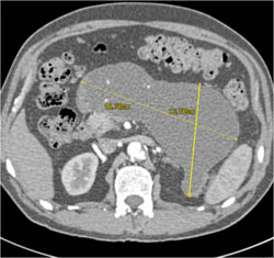 Pseudocyst - CTisus CT Scan