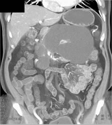 Pseudocyst - CTisus CT Scan