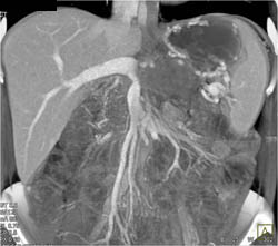 Occlusion of Splenic Vein With Collaterals Due to Pancreatic Cancer - CTisus CT Scan