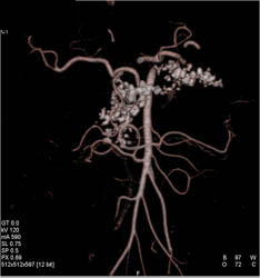 Chronic Pancreatitis - CTisus CT Scan