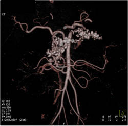 Chronic Pancreatitis - CTisus CT Scan