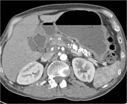 Chronic Pancreatitis - CTisus CT Scan