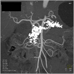 Chronic Pancreatitis - CTisus CT Scan