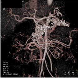 Chronic Pancreatitis - CTisus CT Scan