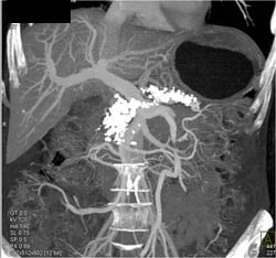 Chronic Pancreatitis - CTisus CT Scan