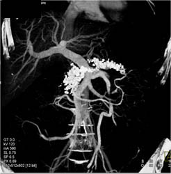 Chronic Pancreatitis - CTisus CT Scan