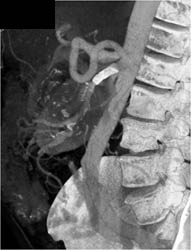 Hepatic Artery Aneurysm With Stent - CTisus CT Scan