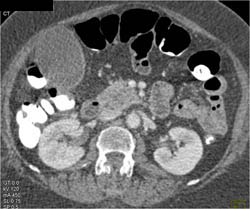 Pancreatic Cancer - CTisus CT Scan