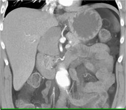 Cystic Nodes Vs Neurogenic Tumor Near the Pancreas - CTisus CT Scan